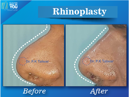 rhinoplasty surgery result